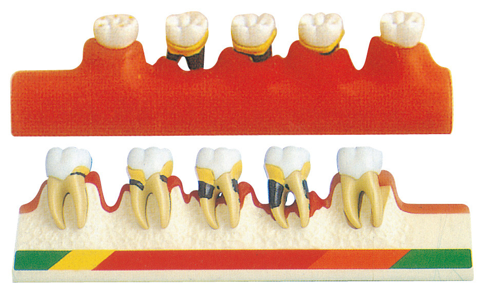 Модель периодонтальным заболеванием включает 5 частей для тренировки зубоврачебных школ