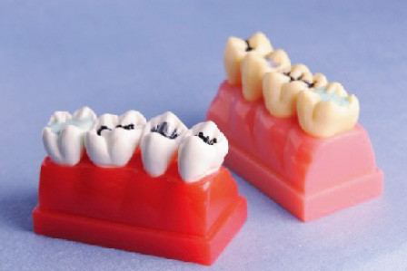 Людская модель зубов для модели демонстрации Sealant и инкрустации 4 времен Lifesize
