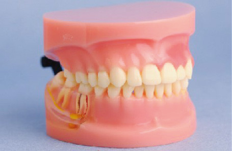 Модель модели зубов периодонтальным заболеванием людской для медицинских коллежей и тренировки клиники