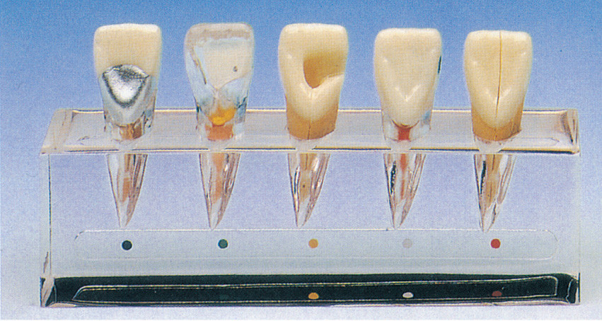 Клиническая модель серии заболеванием зуба о 5 частях для тренировки зубоврачебных школ