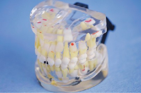 Модель верхней и более низкой челюсти с патологиями для тренировки медицинской клиники