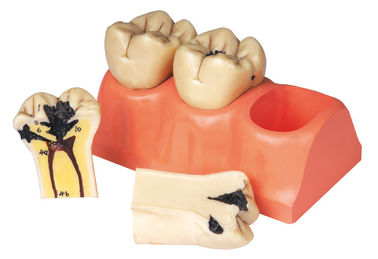 Рассеченная людская модель зубов зубоврачебного заболевания для интернатуры и тренировки студентов