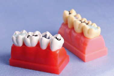 Людская модель зубов для модели демонстрации Sealant и инкрустации 4 времен Lifesize